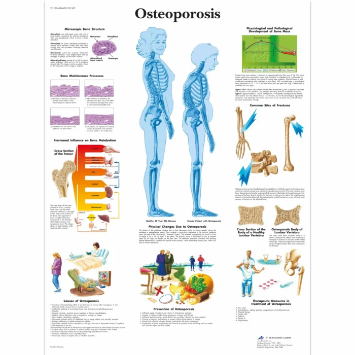 UK 3B Glossy Anatomical Wall Chart – Osteoporosis