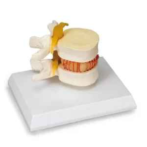 UK 3B Herniated Disk Simulator