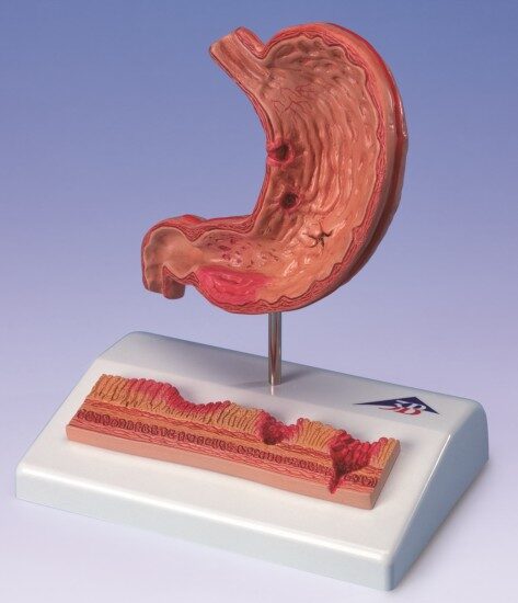UK 3B Stomach with ulcers