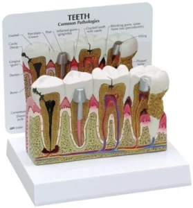 Diseased Teeth and Gums Model