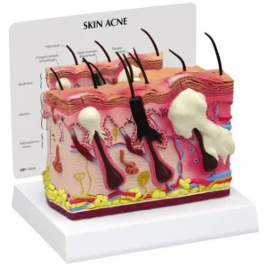 Normal- Acne Skin Model