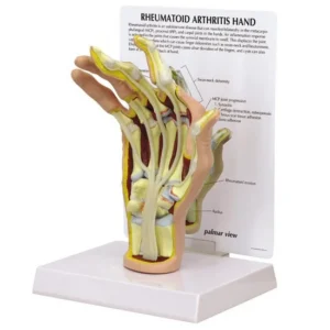 Rheumatoid Arthritis (RA) Hand Model
