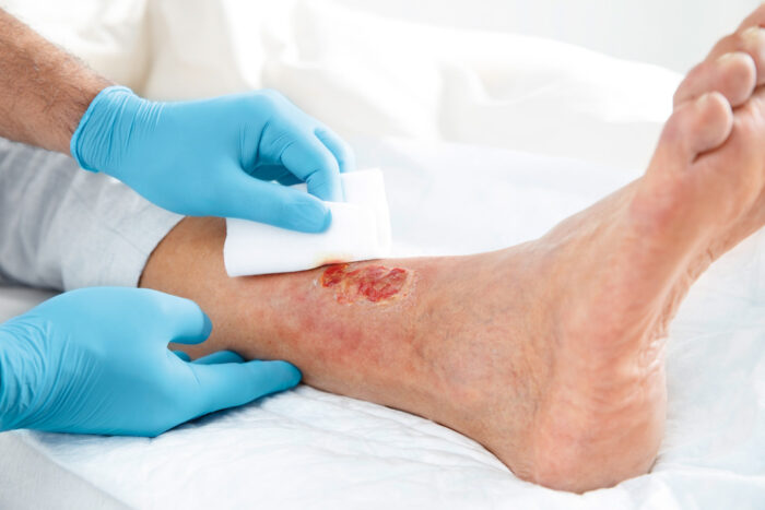 Leukoplast - Compress Cotton Gauze - Sterile - T17 - 12 Ply - 7.5x7.5cm - Pack Of 50(25x2)