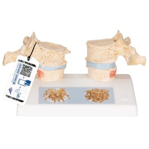 UK 3B Osteoporosis Model